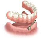 Removable, Implant Anchored Overdenture in Medford